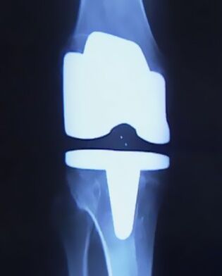 X -ray тасвири зону бо протези сунъӣ пас аз амалиёт барои тағир додани муштарак
